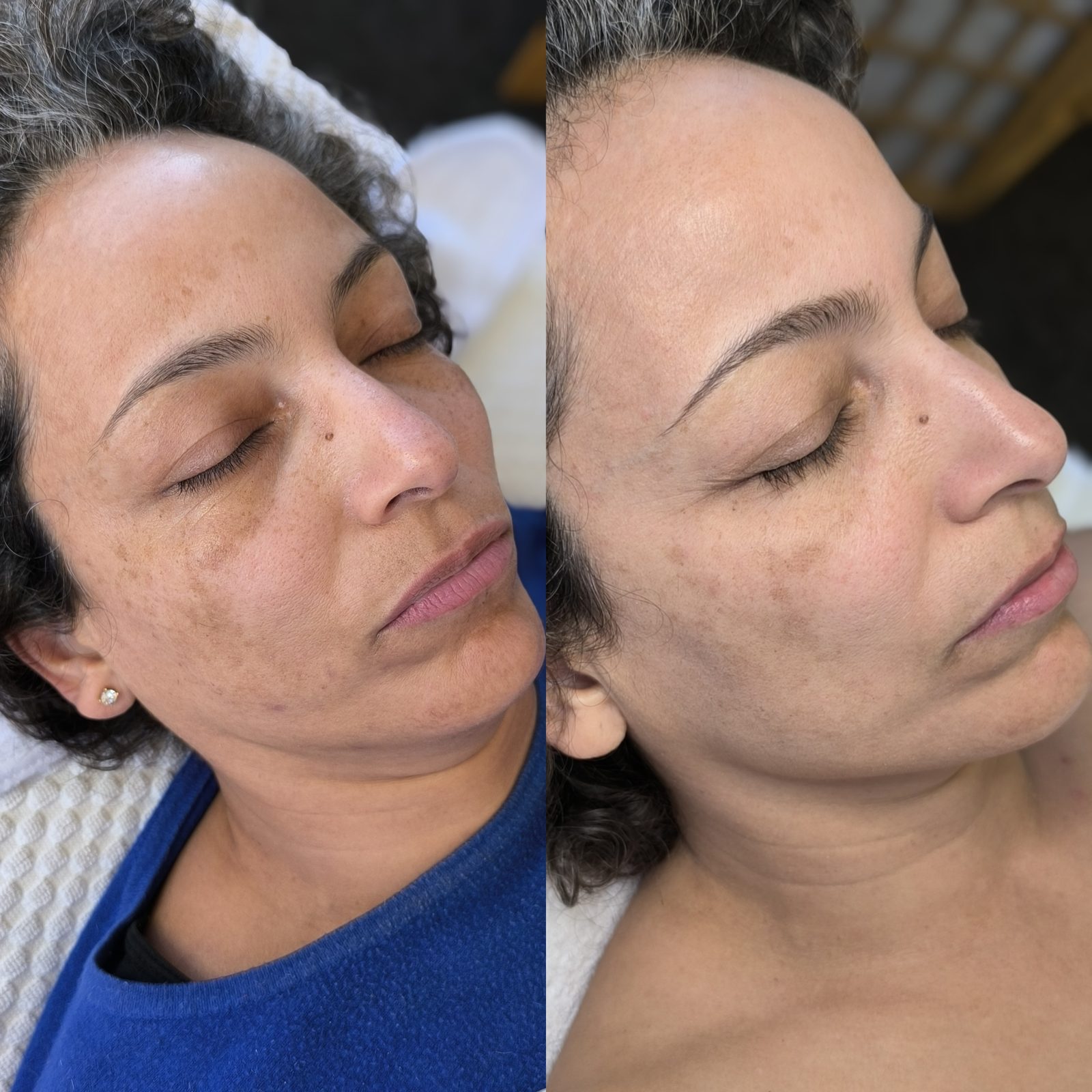 Voor en na resultaat 12 bij Kranicz Beauty