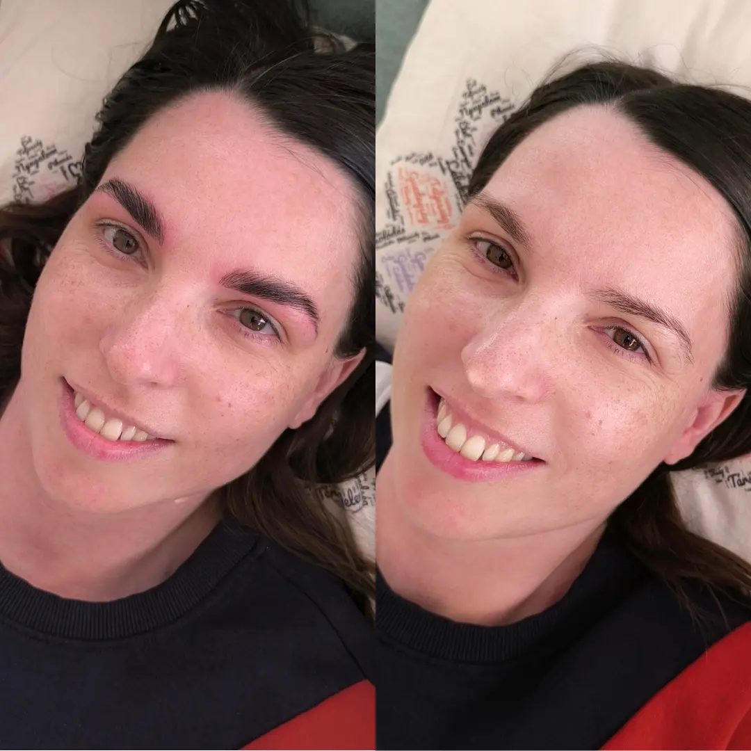 Voor en na resultaat 13 bij Kranicz Beauty