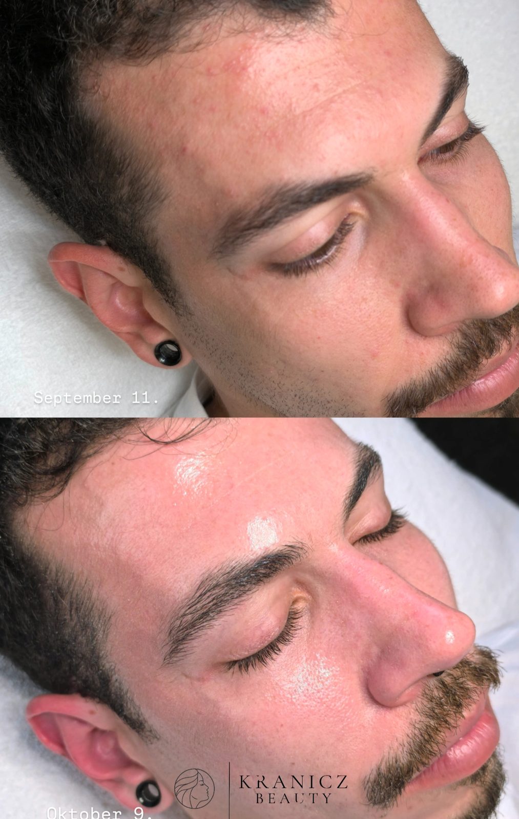 Voor en na resultaat 15 bij Kranicz Beauty