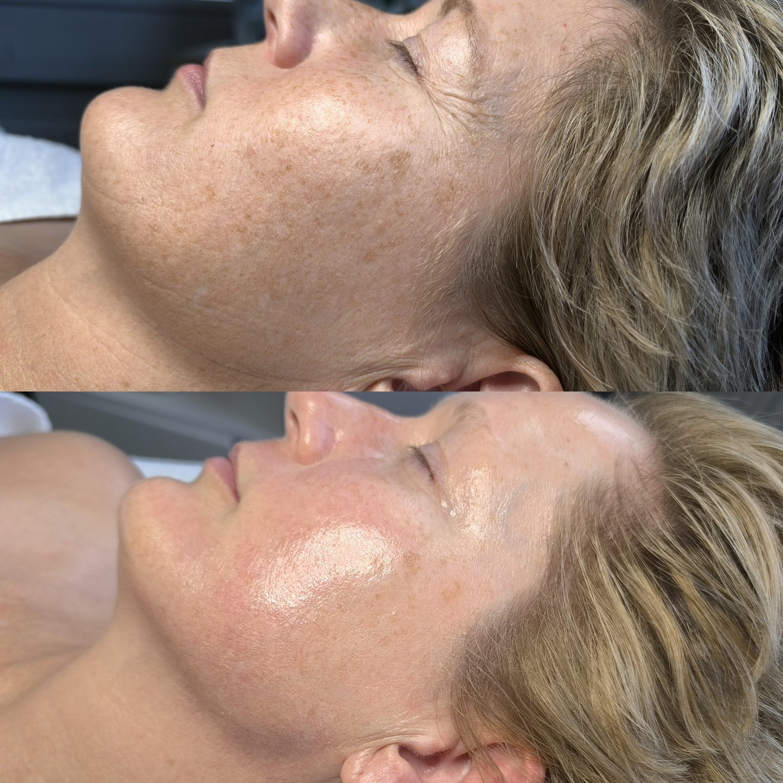 Voor en na resultaat 14 bij Kranicz Beauty